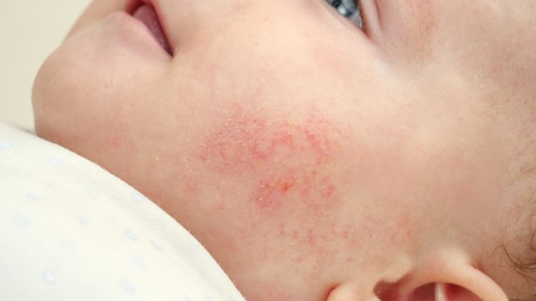 La dermatitis atópica asociada a factores psicosociales
